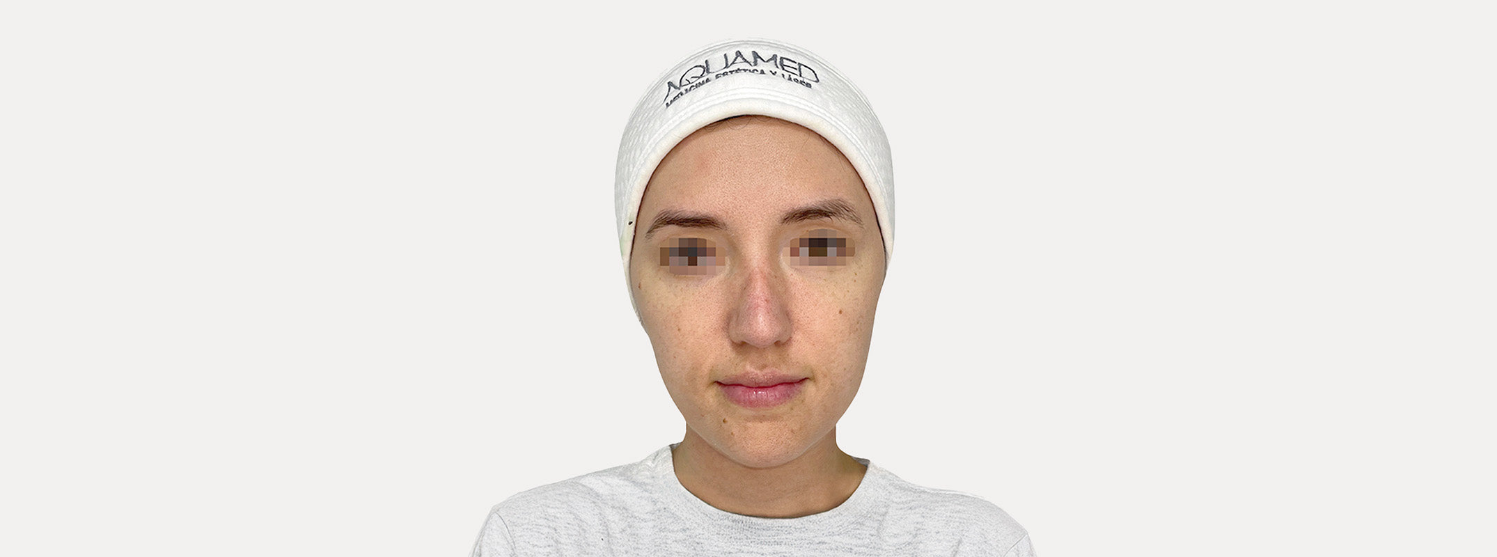 A woman before receiving a Led Light Therapy Deep Facial.