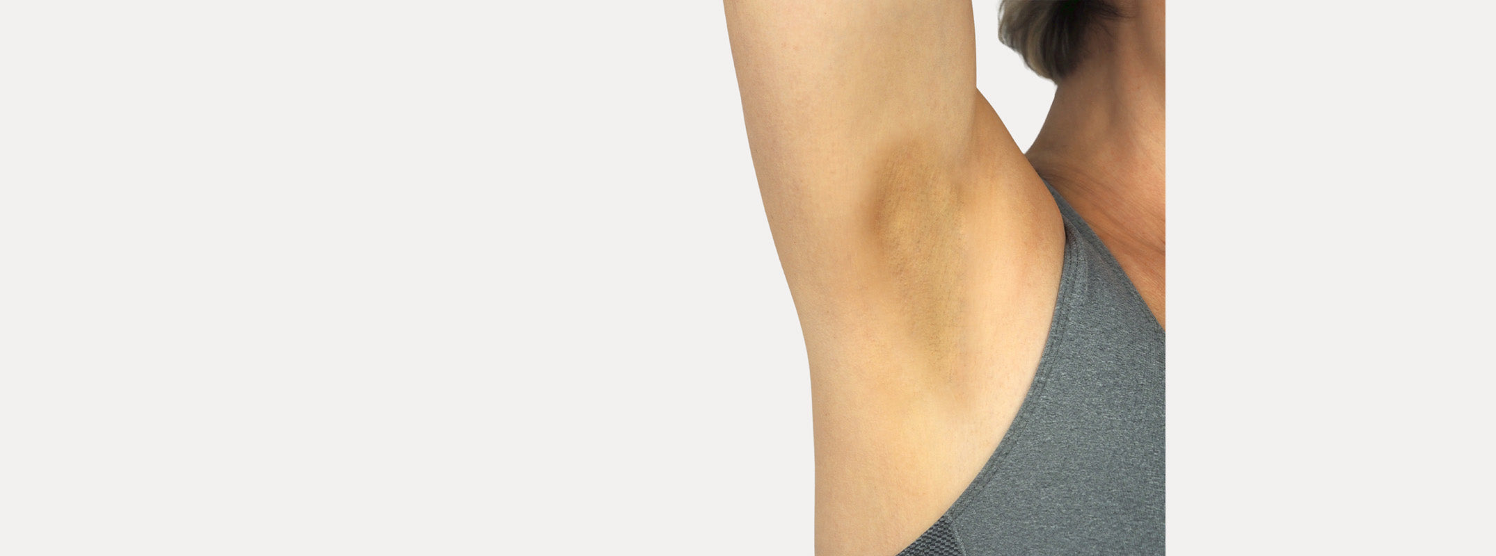 Close up of an armpit before receiving the intimate brightening treatment.