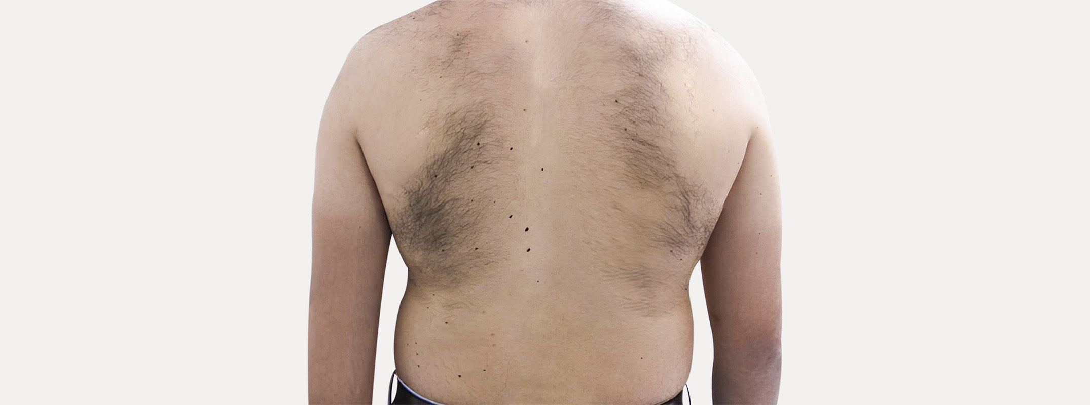 Back of a man before receiving laser hair removal.