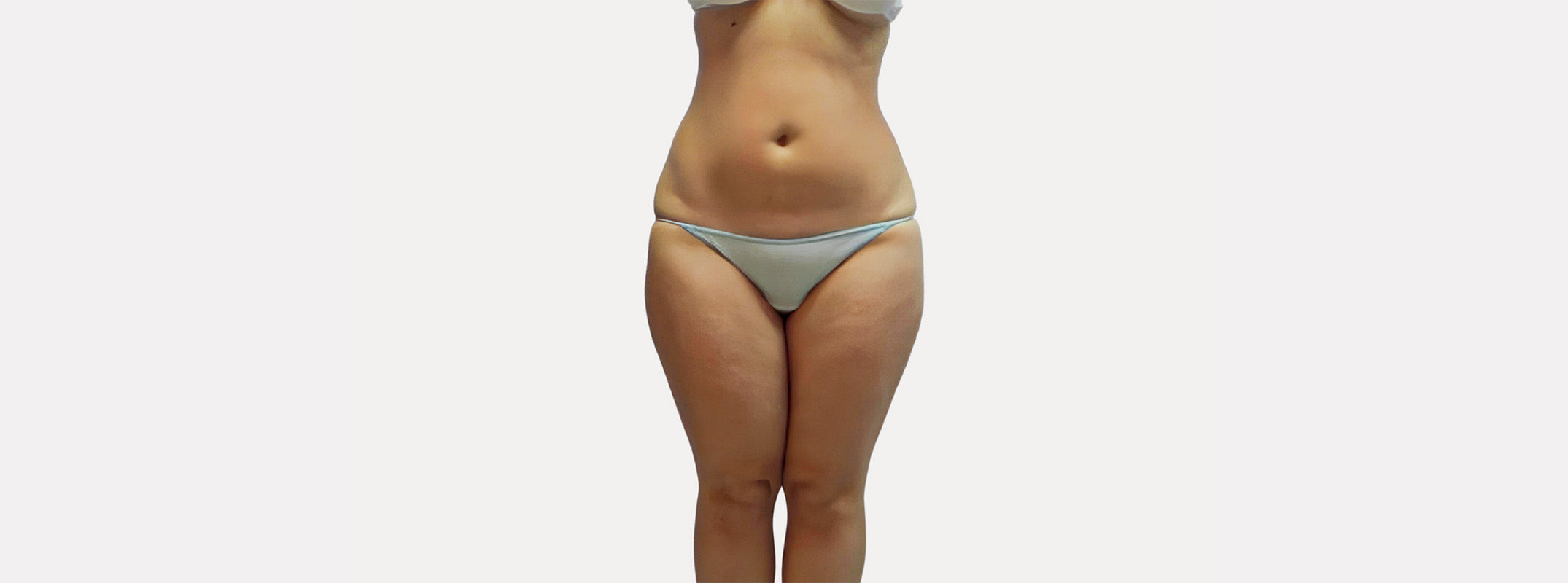 Front view of the body of a woman after receiving a lymphatic drainage.