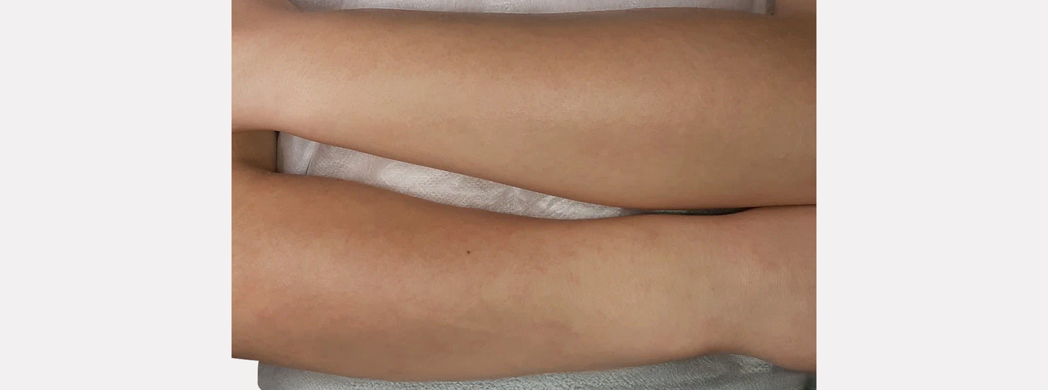 Arms after receiving laser hair removal.