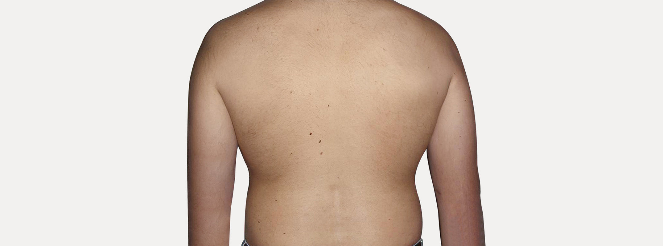 Back of a man after receiving laser hair removal.