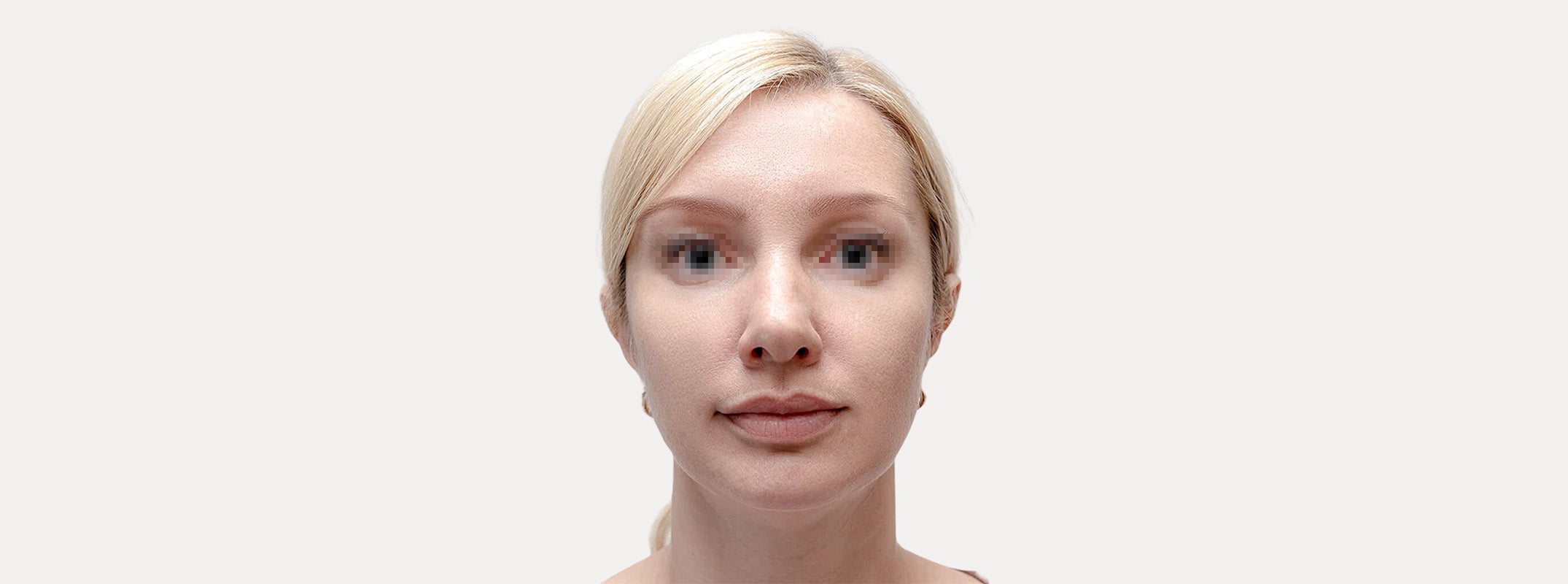 A woman's face after receiving a chemical peel.