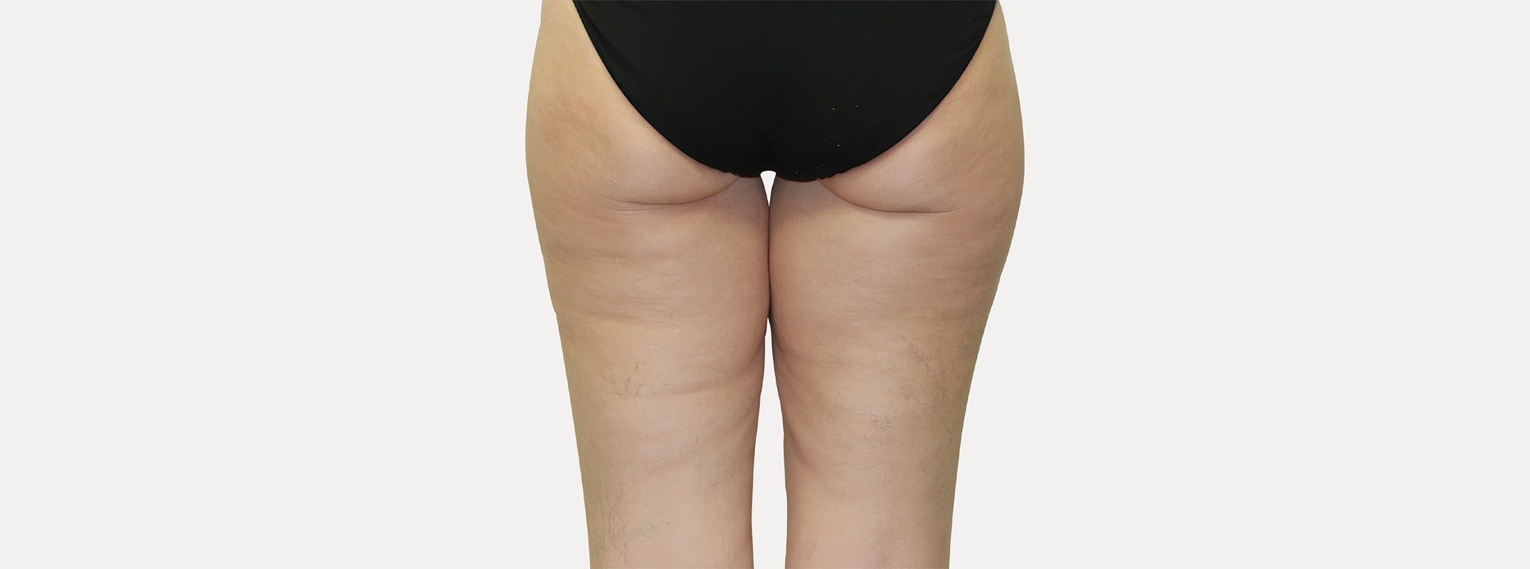 A woman's thighs seen from behind after receiving the anti-cellulite LUDT treatment.