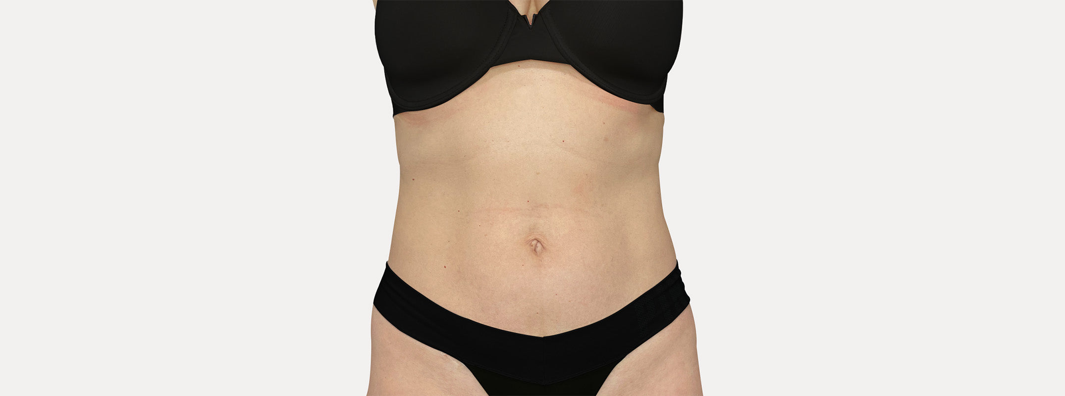 A woman's abdomen after receiving a skin tightening. 