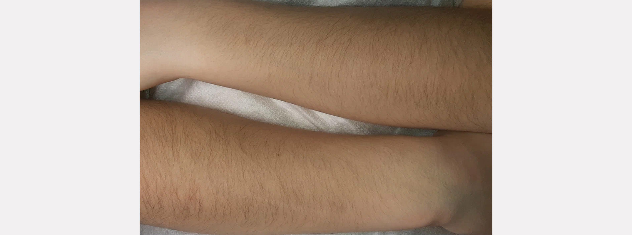 Arms before receiving laser hair removal.