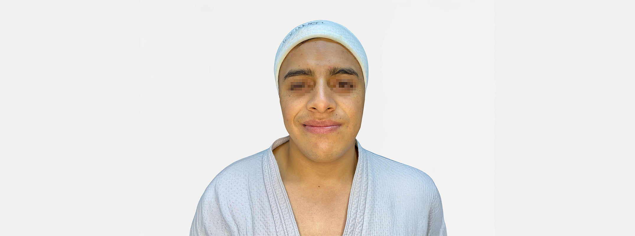 Front view of a man's face before receiving a bardana facial.