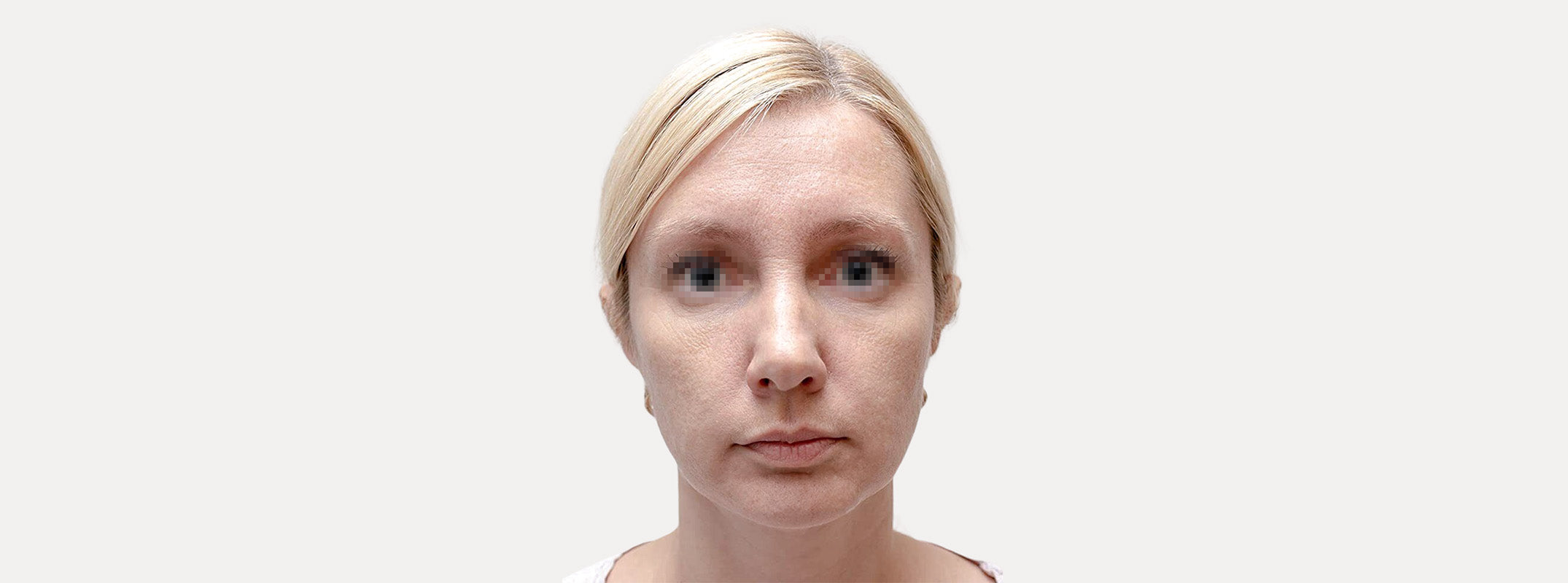 A woman's face before receiving a chemical peel.