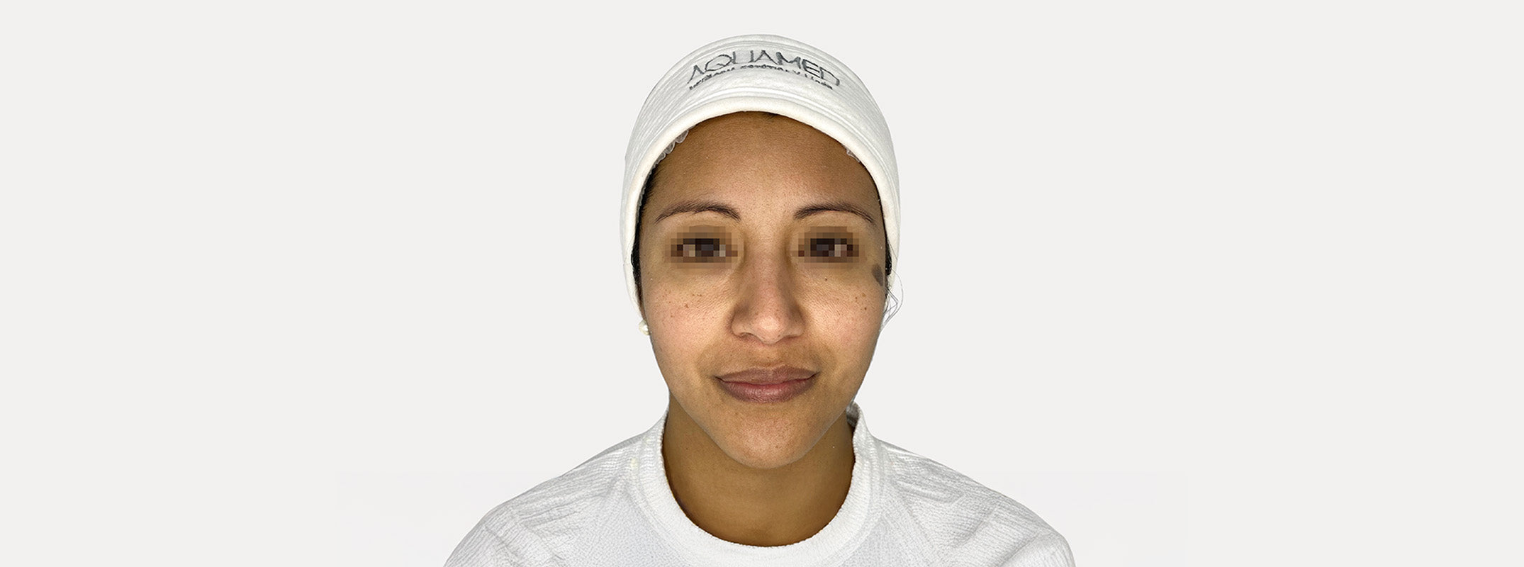 A woman's face before receiving a pink antioxidant facial.