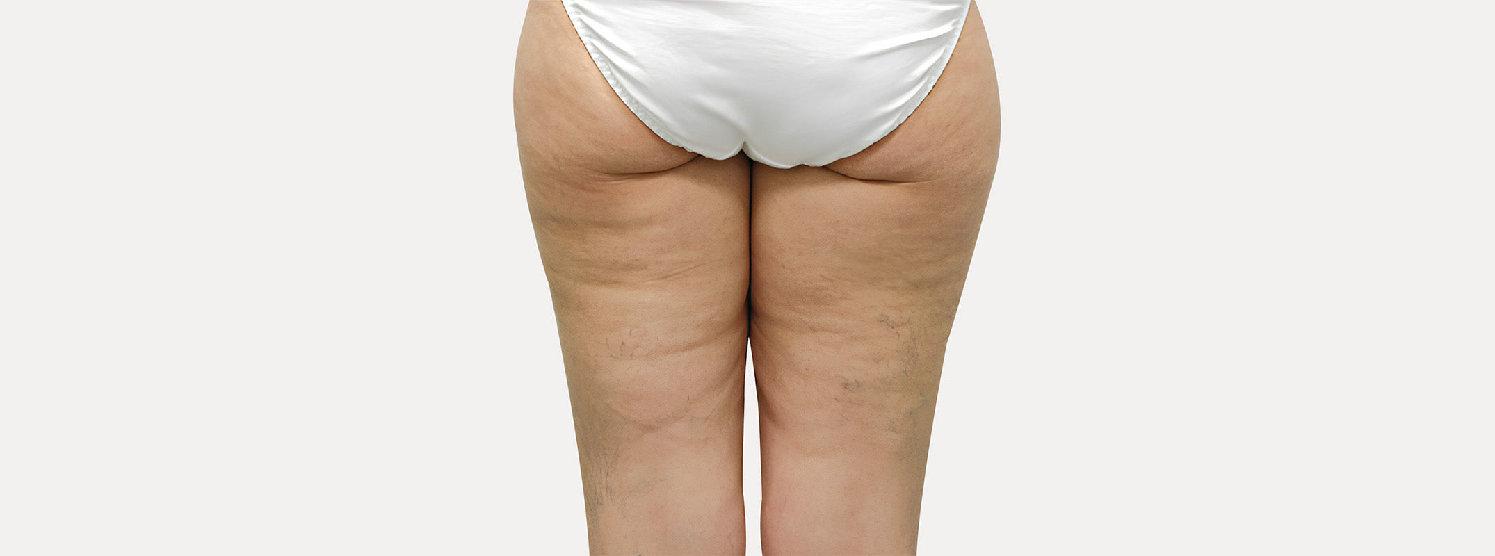 A woman's thighs seen from behind before receiving the anti-cellulite LUDT treatment.