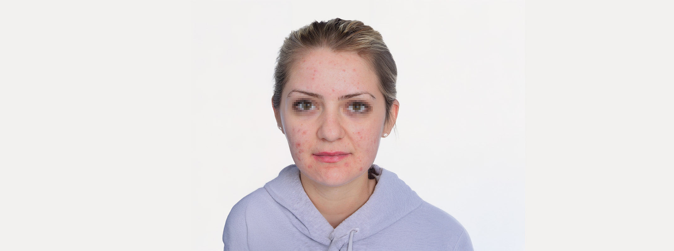 A woman's face before receiving an microneedling.