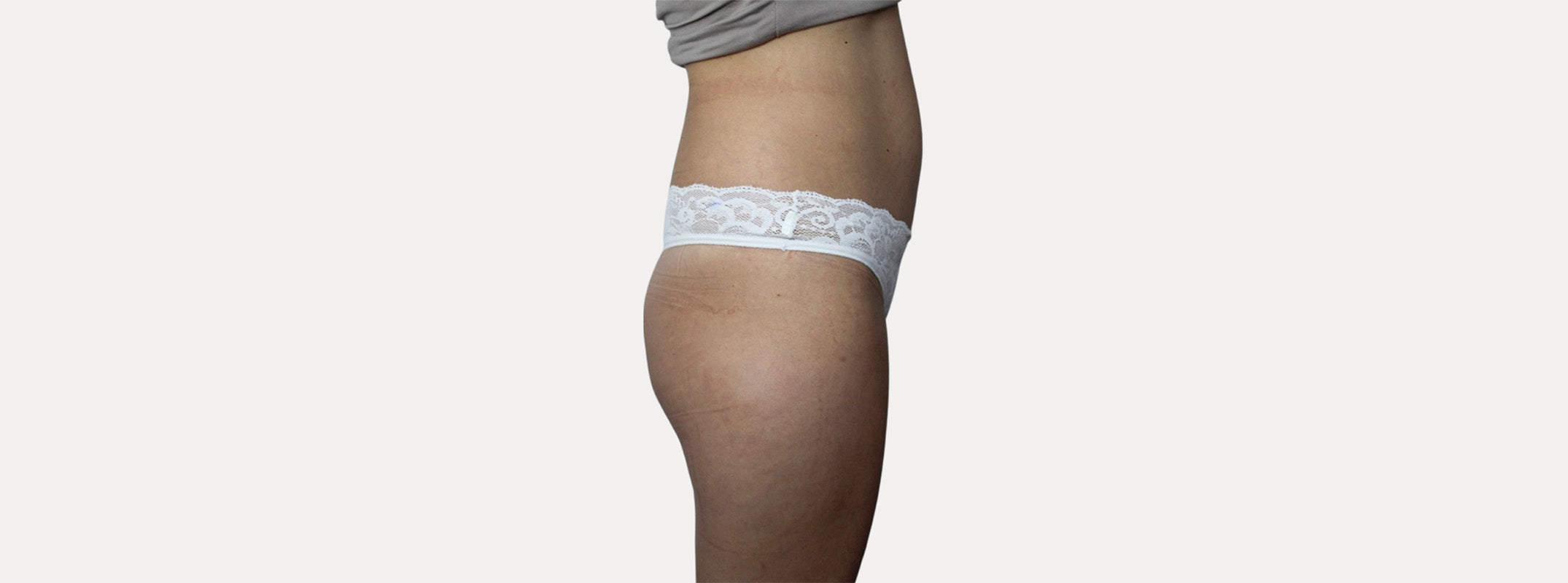 A woman's butt before receiving a non surgical butt lift. 