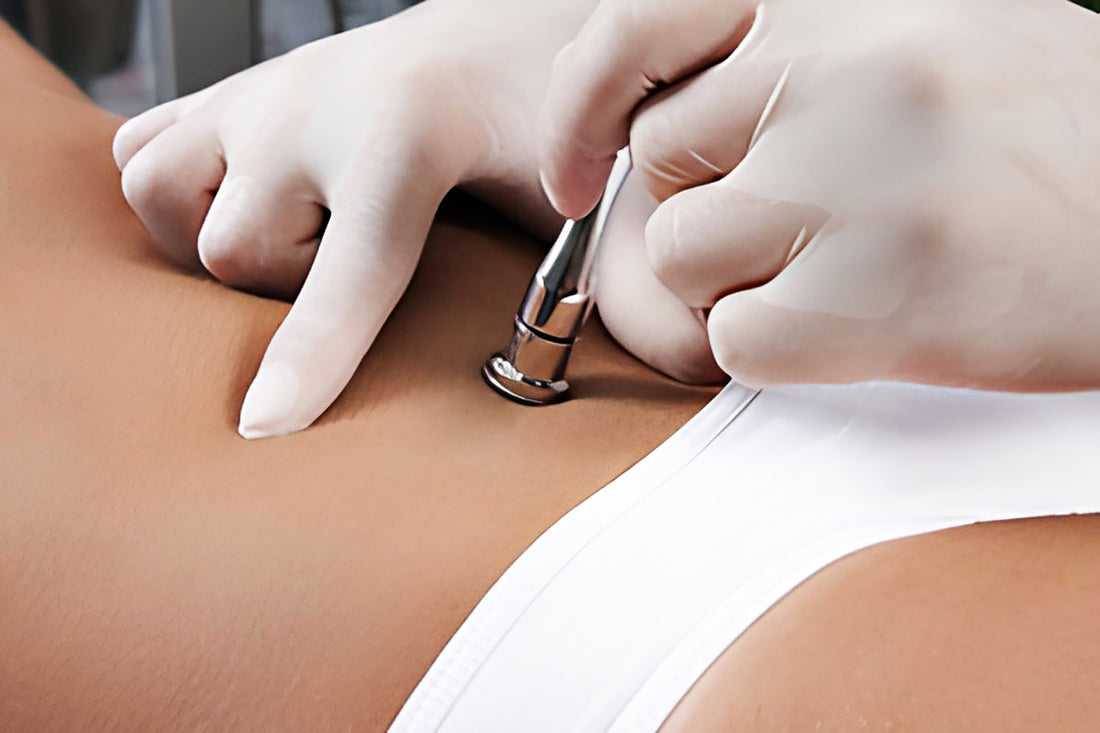 A woman receiving a cosmetic treatment on her low abodmen.