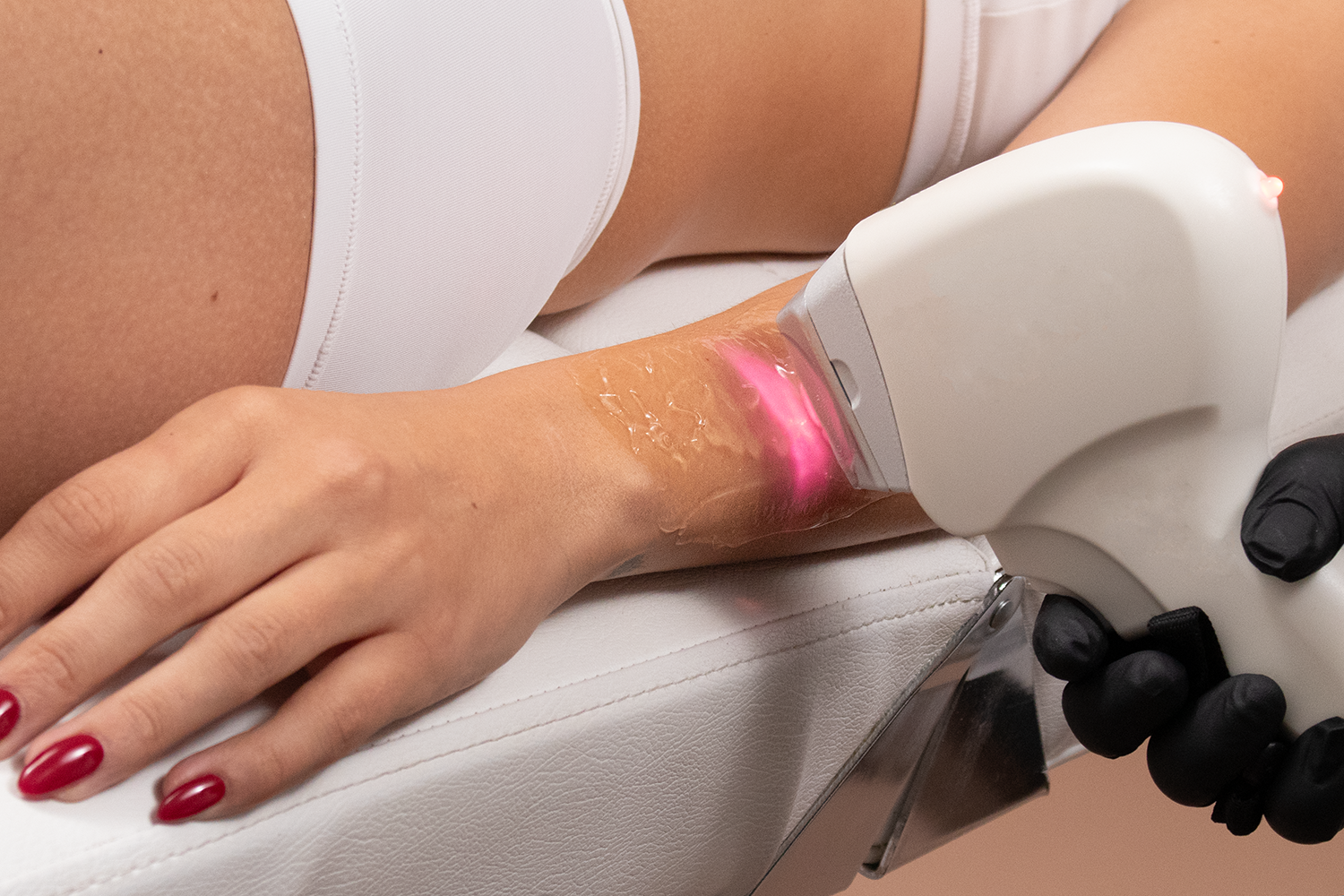 A person receiving laser hair removal on their arm.